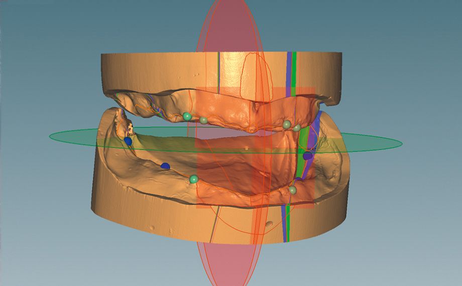 Fig. 3 El software CAD Ceramill Mind guió por el análisis virtual del modelo conforme a TiF®.