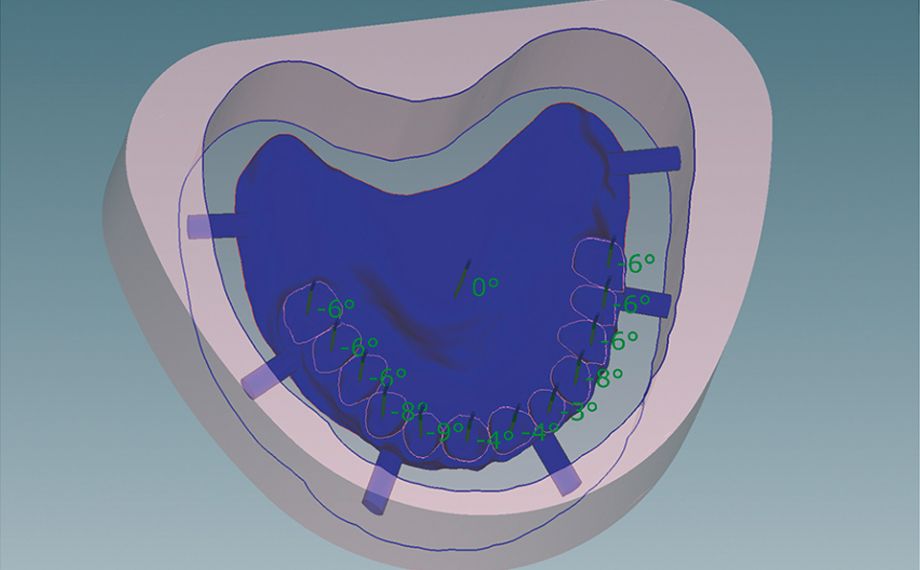 Fig. 10 El anidamiento de la base del maxilar superior diseñada en el disco de cera VITA VIONIC WAX.