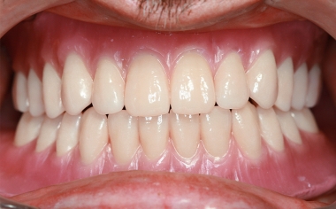 Fig. 11 Durante la prueba clínica en boca no fueron necesarias modificaciones oclusales. El resultado estético fue muy satisfactorio.