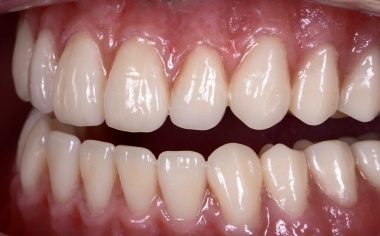 Fig. 13 Se reprodujo de forma natural la anatomía mucogingival mediante el composite de recubrimiento VITA VM LC flow.