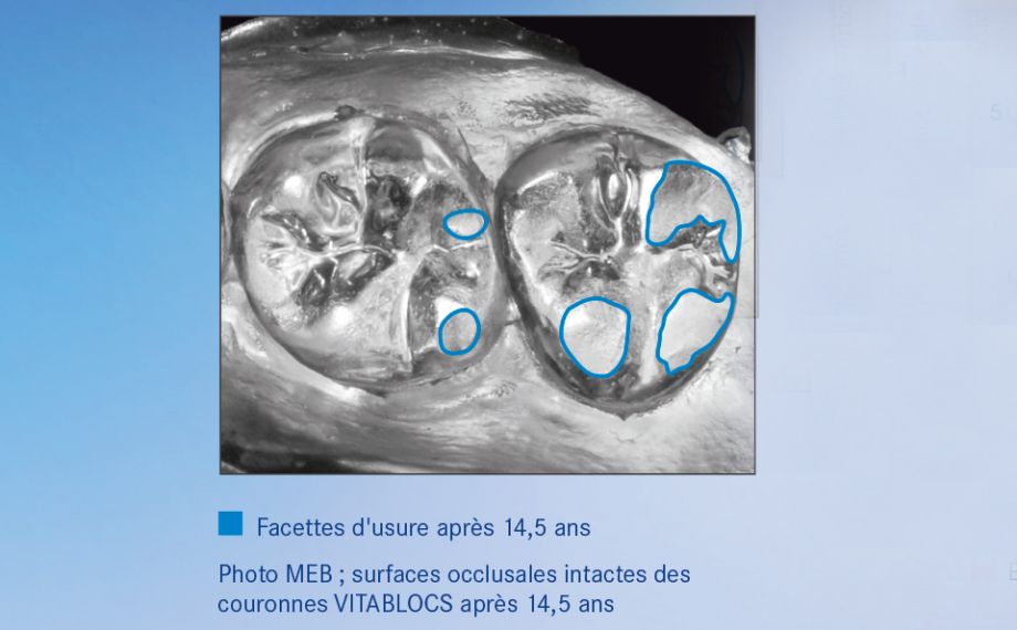 Graphique 2 Dans les évaluations, les restaurations réalisées avec VITABLOCS ont montré un comportement d'abrasion similaire à la nature.Source Étude externe de 2016, université de Zurich/ cabinet au Zürichberg, modèle epoxy d'empreintes après 14,5 ans métallisé à l'or, photographie noir et blanc du modèle (Dr Andreas Bindl)