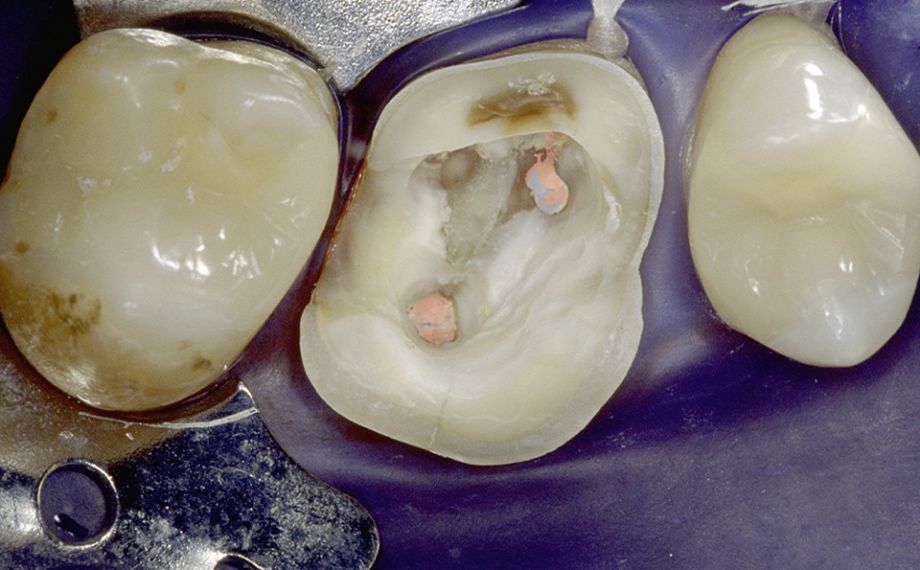Ill. 1a Préparation d’endocouronne avec rétention réduite et liaison par adhérence principalement dans la dentine, moins avantageuse.