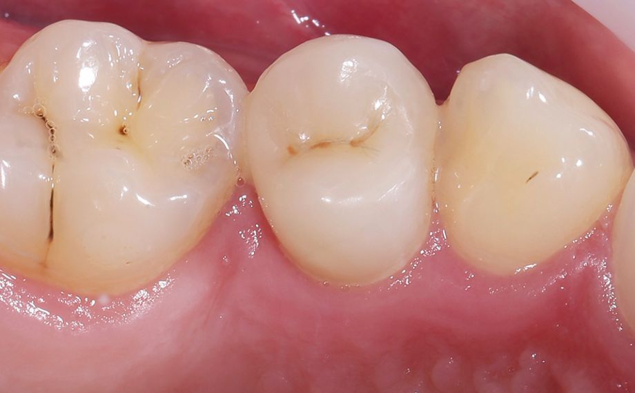 RÉSULTAT Grâce aux excellentes propriétés optiques, la reconstitution en VITA ENAMIC multiColor s’est intégrée tout à fait harmonieusement dans la substance dentaire naturelle.