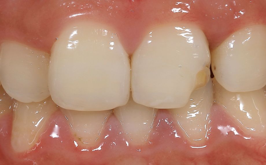 SITUATION INITIALE Situation initiale avec la 21 fracturée lors de la première visite au cabinet dentaire.