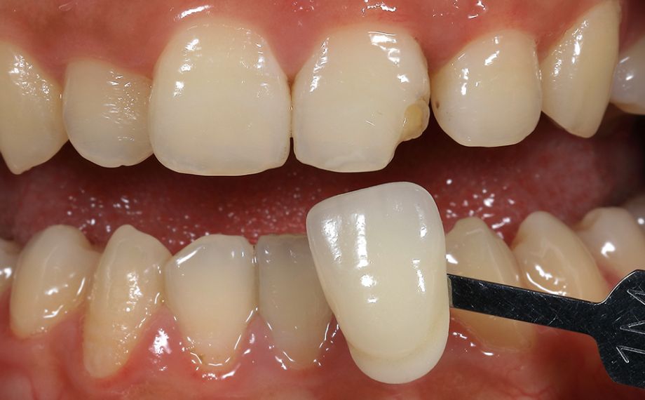 Ill. 3 La couleur de dent a été déterminée de façon systématique en deux étapes à l'aide du teintier VITA Linearguide 3D-MASTER.