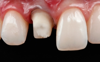 Ill. 1 Préparation coronaire sur la 11 en vue d'une nouvelle restauration définitive.