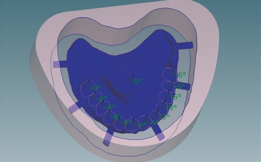 Ill. 10 Positionnement dans la conception de la base prothétique maxillaire dans un disque de cire VITA VIONIC WAX.