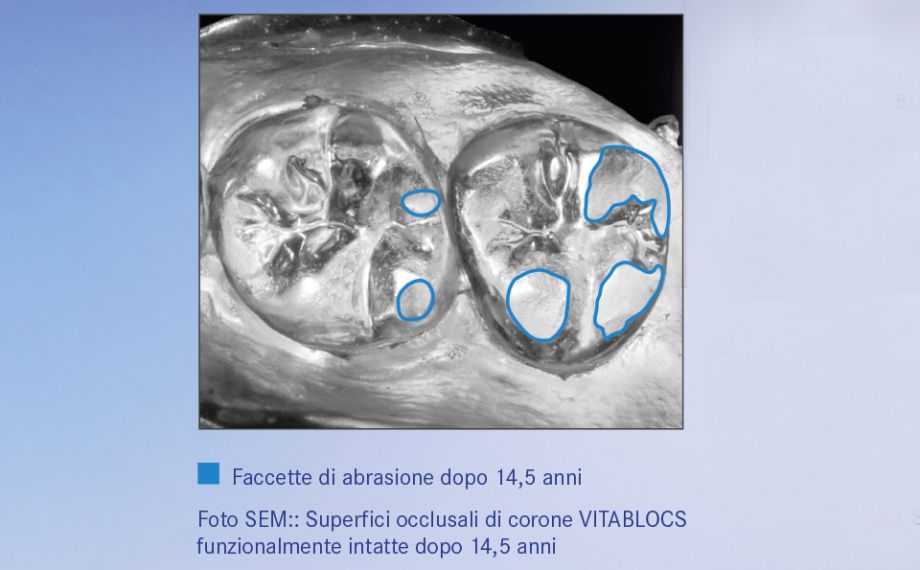Grafico 2 Al controllo i restauri in VITABLOCS presentano un comportmento di abrasione analogo a quello in natura.Fonte: Studio esterno 2016, Università di Zurigo/ Studio a Zürichberg, modello epossidico dell'impronta dopo 14,5 anni, vaporizzato con oro, fotografia b/n del modello (PD Dr. Andreas Bindl)