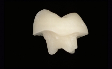 Fig. 1c Corona post-endodontica realizzata con tecnica CAD/CAM dopo finitura e lucidatura.