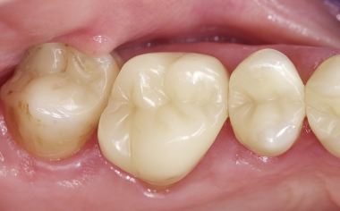 Fig. 1e Situazione della corona post-endodontica 17 anni dopo l'inserimento.