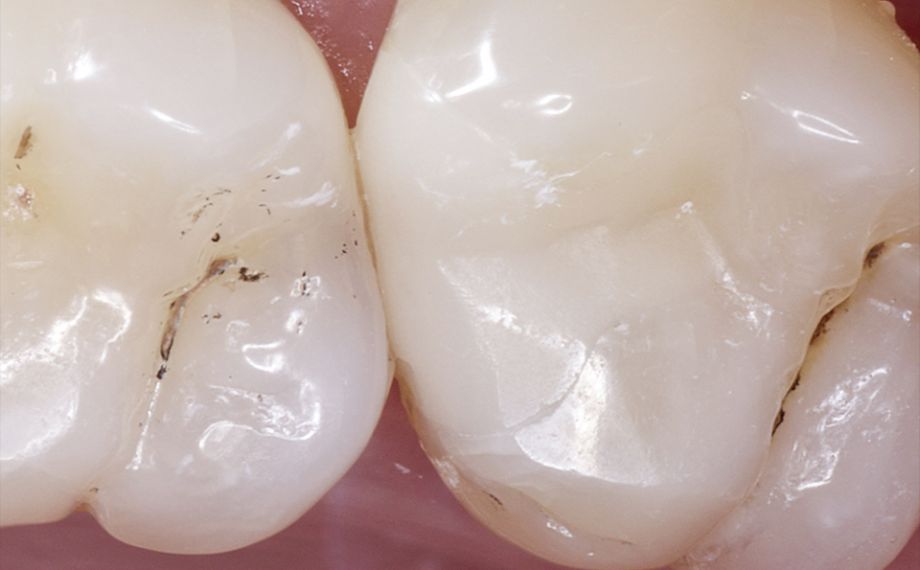Fig. 2b Abrasione equilibrata tra ceramica feldspatica e smalto dentale dopo 14 anni.