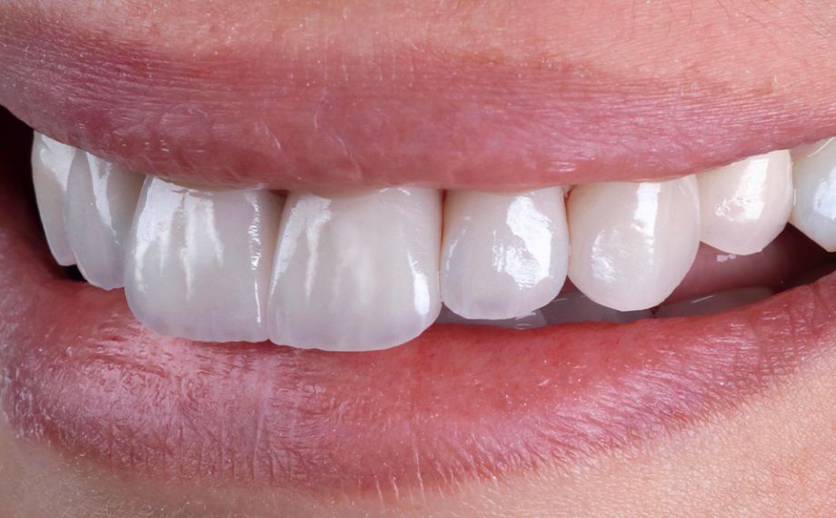 Fig. 10 L'andamento delle labbra e dei bordi incisali sono in armonia