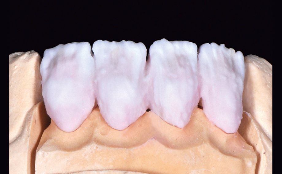 Fig. 7 Prima della prima cottura della dentina è stata ancora aggiunta la massa smalto ENAMEL light.