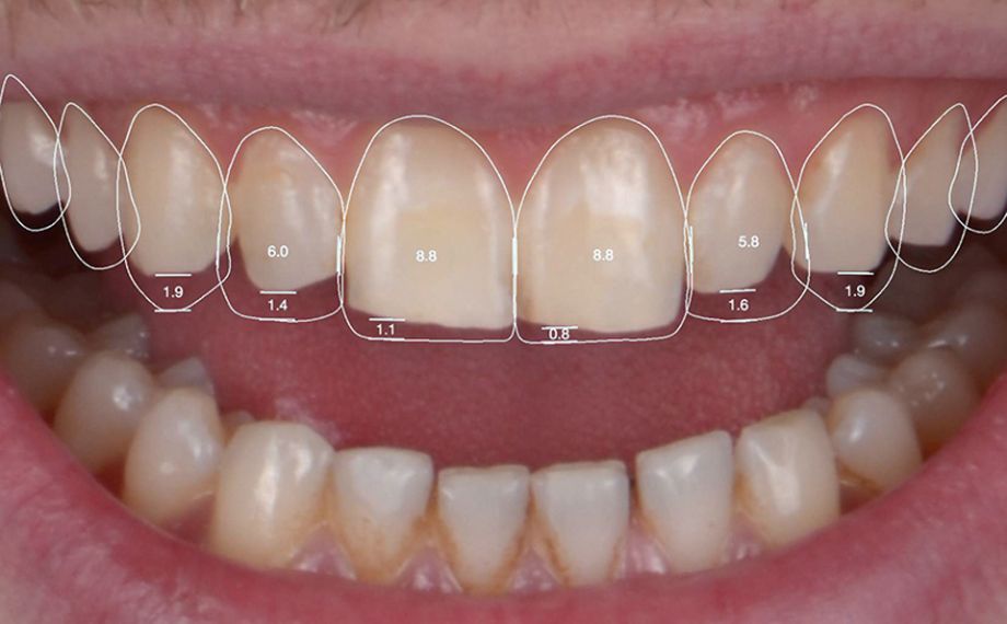 Fig. 3 Con una App è stato possibile modificare virtualmente le proporzioni dentali.