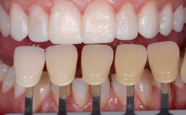 Fog. 6 La determinazione del colore dei denti è stata effettuata con VITA SYSTEM 3D-MASTER.