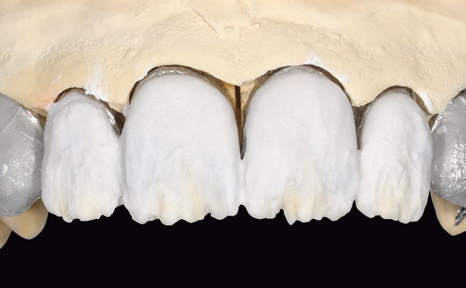 Fig. 12 La parte dentinale è stata stratificata in LUMINARY 1 (bianco) e DENTINE 1M1.