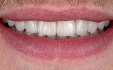 RISULTATO Il paziente è soddisfatto del suo nuovo sorriso. L'andamento delle labbra inferiori e del bordi incisali è in sintonia.