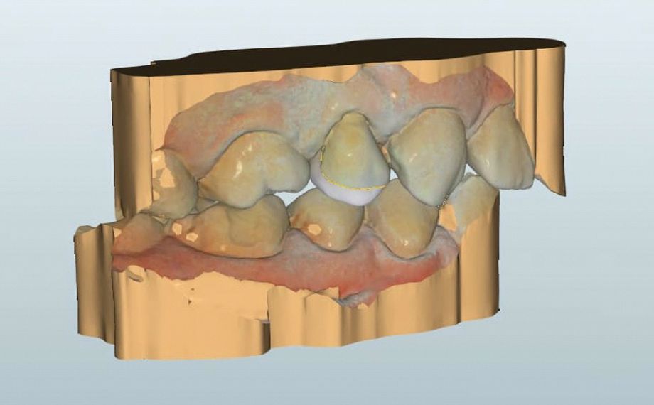 Fig. 5 Progettazione virtuale della riabilitazione coronale post-endodontiche terminata, vista da vestibolare.