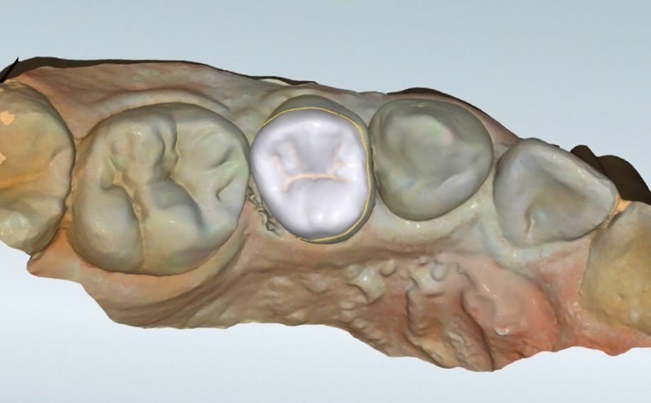 Fig. 6 La progettazione virtuale da occlusale prima del nesting nel blocchetto virtuale.