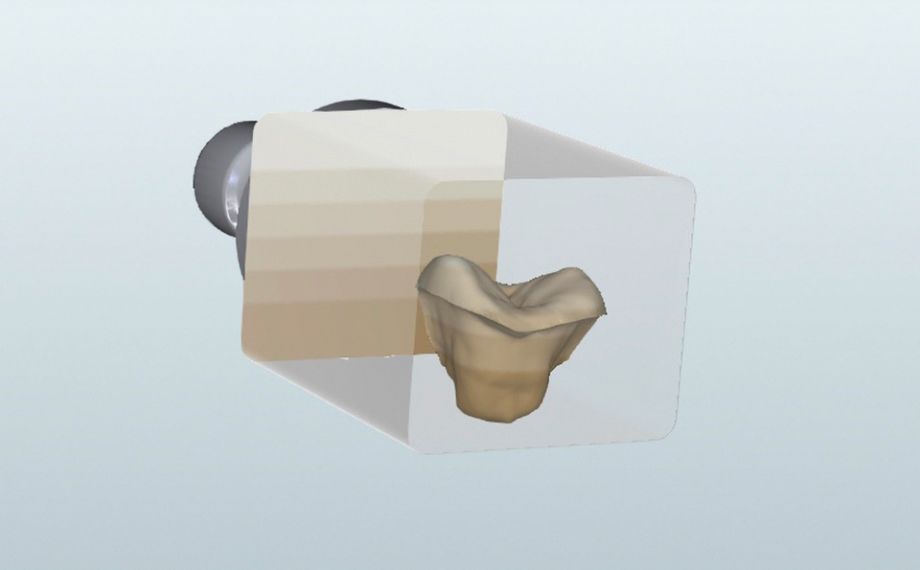 Fig. 7 Grazie ai sei strati finemente sfumati è possibile controllare l'andamento di colore e traslucenza del restauro mediante posizionamento mirato.