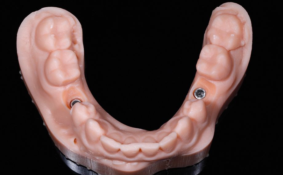 Fig. 5 Il modello realizzato con tecnica additiva con analoghi implantari integrati in regione 34 e 35.