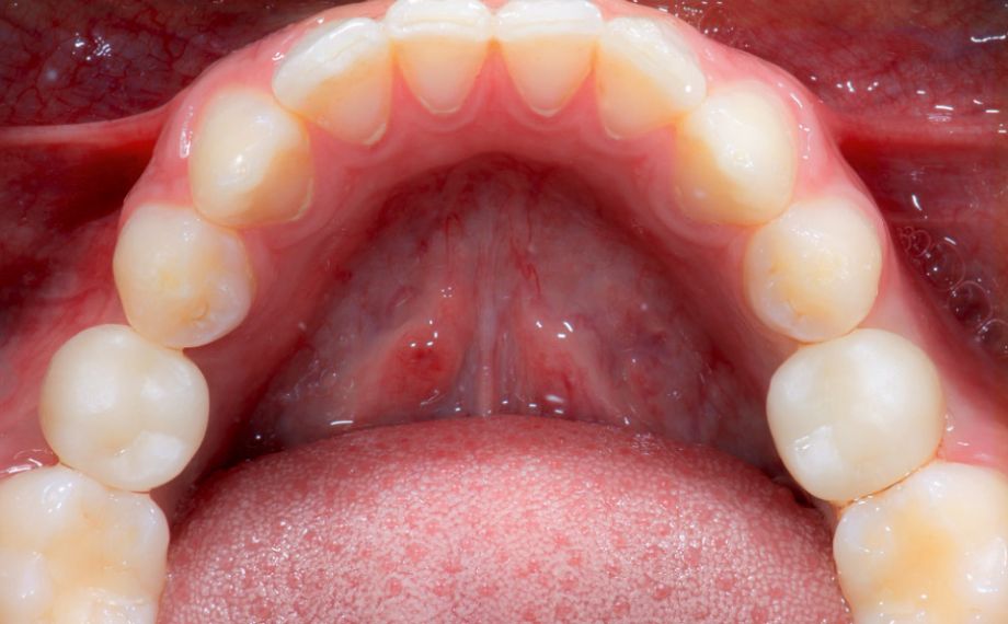 Fig. 8 In fase di prova le sovrastrutture implantoprotesiche si posizionano senza tensioni.