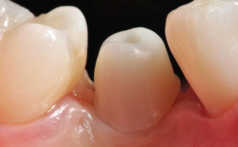 Fig. 9 E'stato possibile configurare in modo ottimale i bordi coronali sull'abutment in ceramica ibrida.