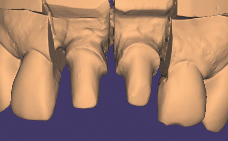 Fig. 6 Il modello maestro è stato digitalizzato con scanner da laboratorio.