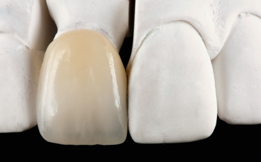 Fig.. 3 Dopo finitura e minimo cut-back la corona è stata individualizzata a livello incisale con VITA VM 11.