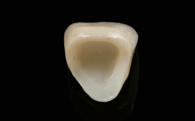Fig. 8 Vista nel lumen coronale, da condizionare per il fissaggio adesivo con acido fluoridrico e silano.