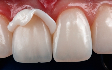 Fig. 9 Corona fissata con metodo adesivo prima dell'eliminazione delle eccedenza di composito.