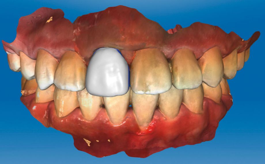 Abb. 4: Für die Konstruktion wurde die ursprüngliche Morphologie von Zahn 11 kopiert.