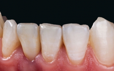 Abb. 12: Die vollkeramische Krone aus VITA SUPRINITY PC integrierte sich morphologisch und farblich exzellent in die Restzahnsubstanz.