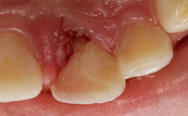 Fallbeispiel 1Abb. 3: Der palatinale Frakturverlauf erstreckte sich tief in den subgingivalen Bereich.