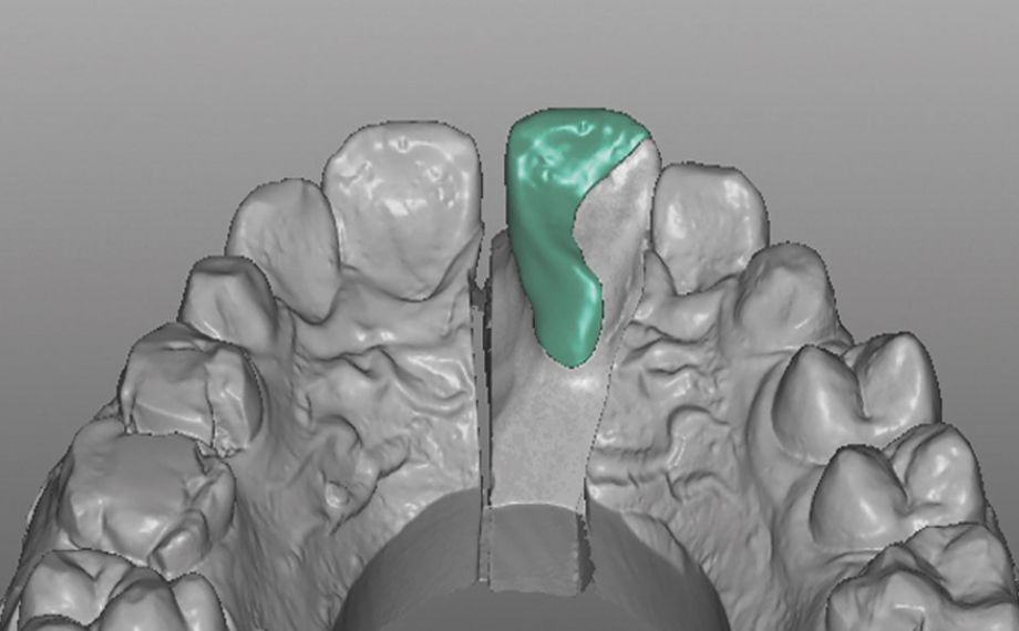 Fallbeispiel 1Abb. 9: Die defektorientierte Konstruktion der hybridkeramischen Restauration von palatinal.