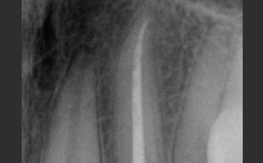 Fallbeispiel 2Abb. 2: Zahn 22 nach der Wurzelkanalbehandlung.