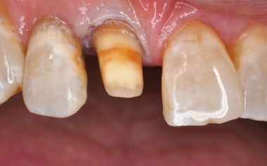 Abb. 1: Ausgangssituation: Um den Zahn 11 nachhaltig zu stabilisieren, wurde dieser für eine vollkeramische Krone präpariert.