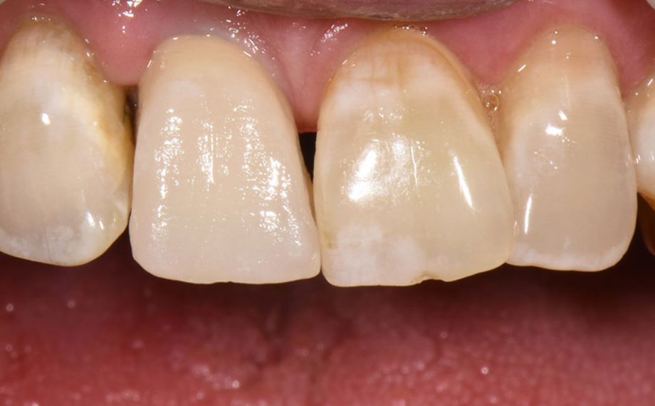 Abb. 3: Das Ergebnis nach dem ersten Dentinbrand bei der klinischen Einprobe.