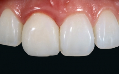 Abb. 2: Die Krone an Zahn 11 zeigte sich leblos, ohne lichtoptische Effekte.