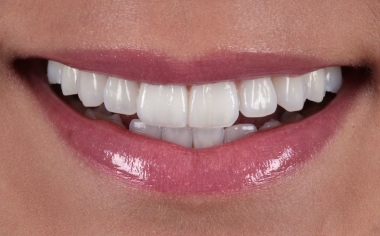 Abb. 10: Der Zahnbogen in der ästhetischen Zone harmonierte mit dem Lippenverlauf.