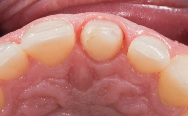 Fig. 4: During the preparation, the minimum layer thicknesses of the restoration was observed.