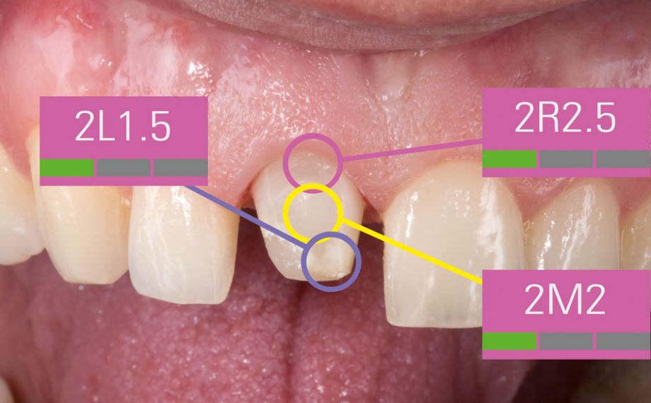 Fig. 7: Since the shade of the prepared tooth affects the shade of the restoration, a 3-point measurement was conducted.