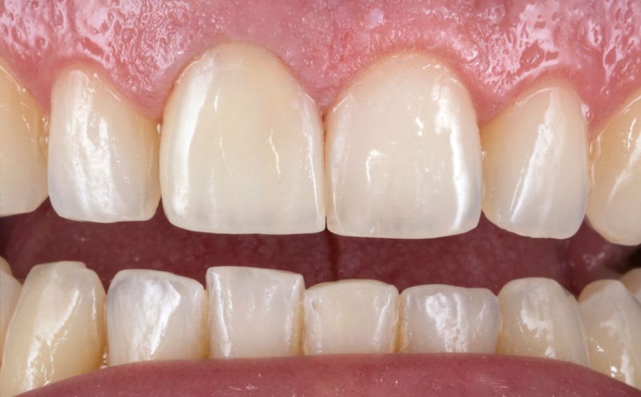 Fig. 9: The highly esthetic monolithic crown naturally integrated into the dental arch.
