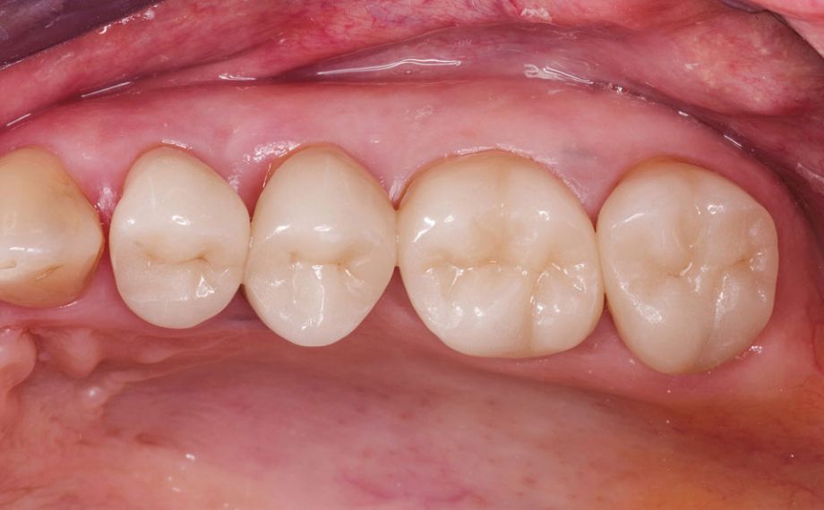 Fig. 7: VITABLOCS crowns during a follow-up appointment after 17 years.