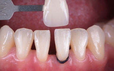 Fig. 2: The tooth shade determination with the VITA Toothguide 3D-MASTER covered the tooth shade range and made it possible to select a suitable block.