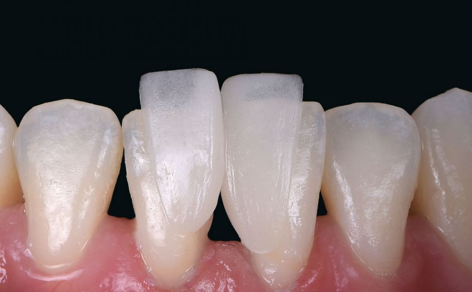 Fig. 6: The clinical try-in showed the pronounced chameleon effect of the hybrid ceramic material.