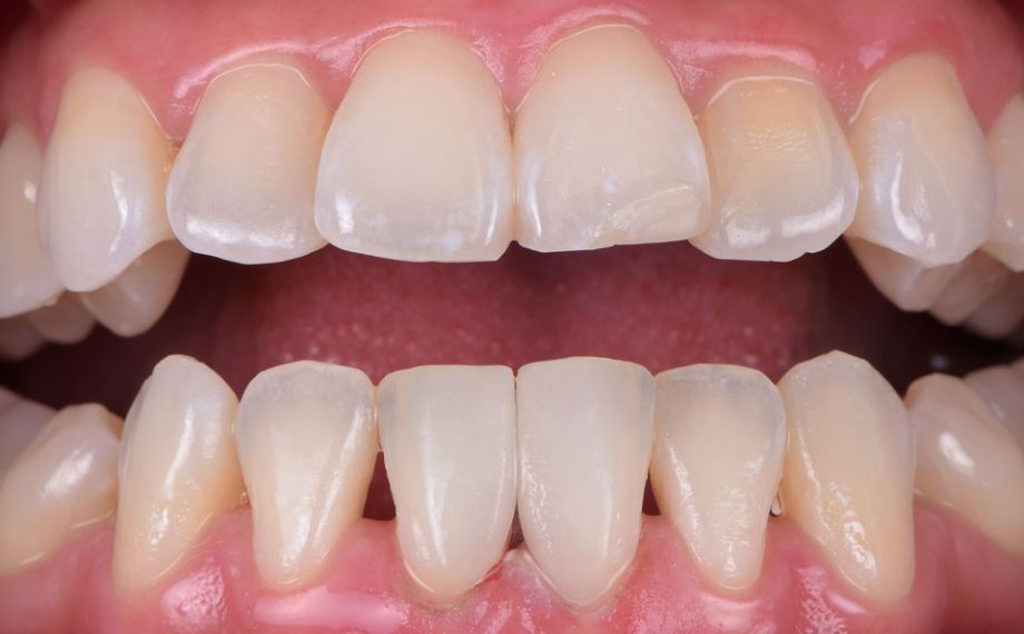 Fig. 7: The two microveneers blended invisibly into the natural row of teeth.
