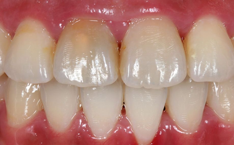 Fig. 1: Initial situation: The right middle incisor in the upper jaw, which had been treated with a root canal, had become discolored.