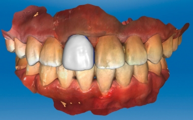 Fig. 4: The original morphology of tooth 11 was copied for the design.