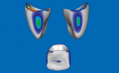 Fig. 5: In the CEREC Premium 4.4.4 software, the occlusal and proximal contact point areas could be modified.